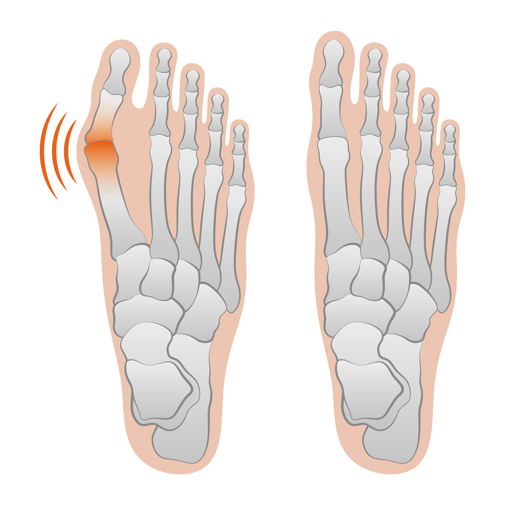 Bei Hallux valgus entsteht der gefürchtete Ballenzeh durch eine Deformierung.