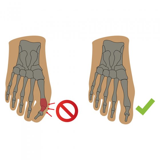 Hallux Nachtbandage 