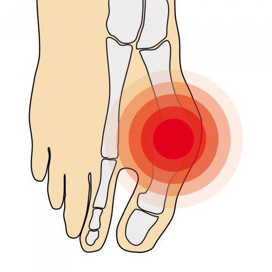 Hallux-Valgus-Bandage 