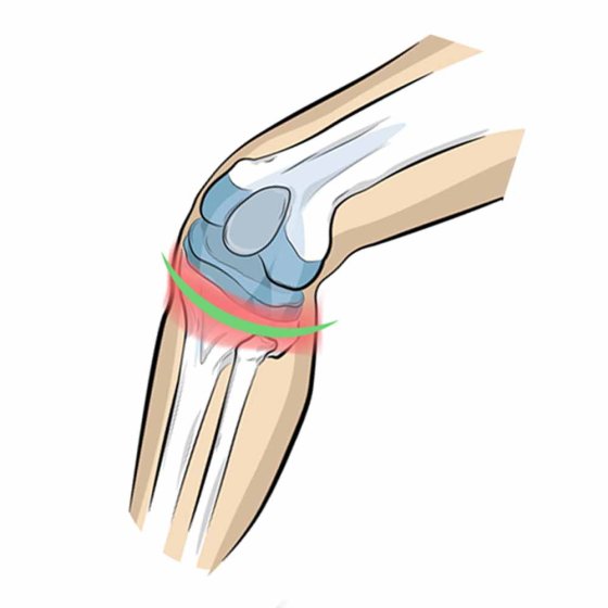 Kniebandage Patellasehne 