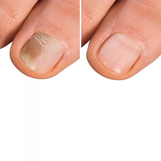 Fuß- und Nagelpilzspray 